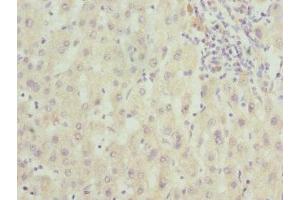 Immunohistochemistry of paraffin-embedded human liver cancer using ABIN7166597 at dilution of 1:100 (Small EDRK-Rich Factor 1A (SERF1A) (AA 140-240) antibody)