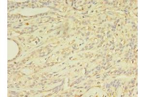 Immunohistochemistry of paraffin-embedded human breast cancer using ABIN7144889 at dilution of 1:100 (ABCB5 antibody  (AA 547-760))