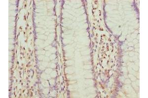 Immunohistochemistry of paraffin-embedded human colon cancer using ABIN7152521 at dilution of 1:100