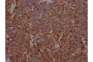 IHC image of ABIN7127670 diluted at 1:100 and staining in paraffin-embedded human lung cancer performed on a Leica BondTM system. (Recombinant PD-L1 antibody)