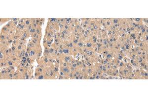 Immunohistochemistry of paraffin-embedded Human thyroid cancer tissue using ZFAND5 Polyclonal Antibody at dilution of 1:35(x200) (ZFAND5 antibody)