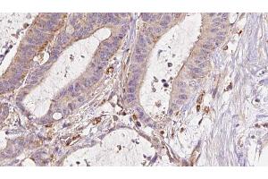 ABIN6273044 at 1/100 staining Human liver cancer tissue by IHC-P. (ETFB antibody  (Internal Region))