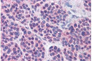 Anti-MBOAT4 antibody  ABIN960793 IHC staining of human thyroid, medullary carcinoma. (MBOAT4 antibody  (Internal Region))