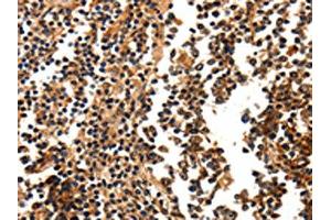 The image on the left is immunohistochemistry of paraffin-embedded Human tonsil tissue using ABIN7190676(FOXB2 Antibody) at dilution 1/5, on the right is treated with synthetic peptide. (FOXB2 antibody)
