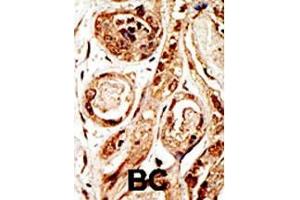 Formalin-fixed and paraffin-embedded human cancer tissue reacted with the primary antibody, which was peroxidase-conjugated to the secondary antibody, followed by AEC staining. (SENP3 antibody  (N-Term))