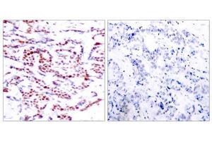 Immunohistochemical analysis of paraffin-embedded human breast carcinoma tissue using ATF-2 (phospho-Thr71 or 53) antibody (E011031). (ATF2 antibody  (pThr53, pThr71))