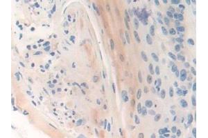 Detection of CENPI in Human Skin cancer Tissue using Polyclonal Antibody to Centromere Protein I (CENPI) (CENPI antibody  (AA 292-528))