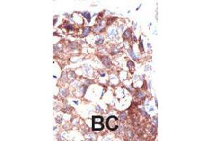 Formalin-fixed and paraffin-embedded human cancer tissue reacted with UBQLN1 polyclonal antibody  , which was peroxidase-conjugated to the secondary antibody, followed by DAB staining. (Ubiquilin 1 antibody  (N-Term))