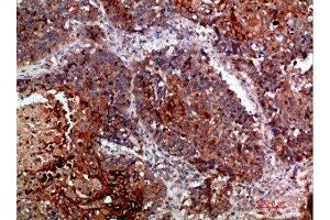 Immunohistochemical analysis of paraffin-embedded human-lung-cancer, antibody was diluted at 1:200