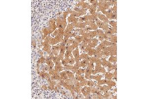 Immunohistochemical analysis of paraffin-embedded Human hepatocarcinoma tissue using (ABIN657465 and ABIN2846493) performed on the Leica® BOND RXm.