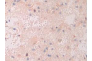 Detection of ATF4 in Human Glioma Tissue using Polyclonal Antibody to Activating Transcription Factor 4 (ATF4) (ATF4 antibody  (AA 130-347))