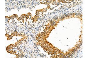 ABIN6257600 and ABIN6275123 at 1/100 staining Human colorectal cancer by IHC-P. (EIF5B antibody  (C-Term))