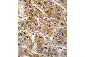 Formalin-fixed and paraffin-embedded human hepatocarcinoma tissue reacted with AGT antibody (N-term), which was peroxidase-conjugated to the secondary antibody, followed by DAB staining. (AGT antibody  (N-Term))