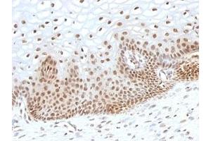 Formalin-fixed, paraffin-embedded human cervical carcinoma stained with TOX3 antibody (TOX3/1123). (TOX3 antibody  (AA 200-400))