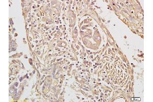 Formalin-fixed and paraffin embedded human colon cancer labeled with Anti-TAK1/MAP3K7 Polyclonal Antibody, Unconjugated (ABIN701185) followed by conjugation to the secondary antibody and DAB staining (TR4 antibody  (AA 560-600))