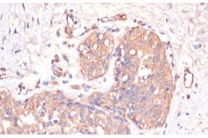 Immunohistochemistry of paraffin-embedded Human mammary cancer using Caspase-3 Polyclonal Antibody at dilution of 1:200 (40x lens). (Caspase 3 antibody)