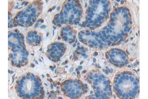 DAB staining on IHC-P; Samples: Human Breast cancer Tissue (Annexin A3 antibody  (AA 19-154))