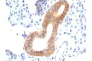 Formalin-fixed, paraffin-embedded human melanoma stained with CD86 antibody (SPM600). (CD86 antibody)