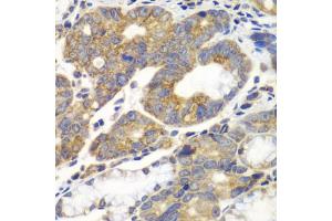 Immunohistochemistry of paraffin-embedded human gastric cancer using PFKM antibody. (PFKM antibody)