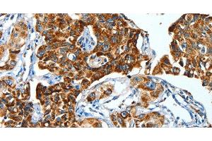 Immunohistochemistry of paraffin-embedded Human lung cancer using ALDH6A1 Polyclonal Antibody at dilution of 1:45 (ALDH6A1 antibody)