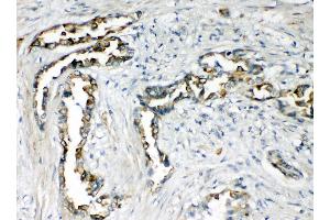 Anti-CXCR1 antibody, IHC(P) IHC(P): Human Lung Cancer Tissue (CXCR1 antibody  (N-Term))