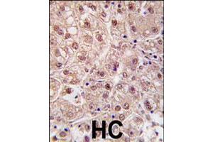 Formalin-fixed and paraffin-embedded human hepatocellular carcinoma reacted with PSMA5 polyclonal antibody  , which was peroxidase-conjugated to the secondary antibody, followed by DAB staining. (PSMA5 antibody  (N-Term))