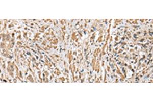 Immunohistochemistry of paraffin-embedded Human prost ate cancer tissue using CNPY2 Polyclonal Antibody at dilution of 1:25(x200) (CNPY2/MSAP antibody)