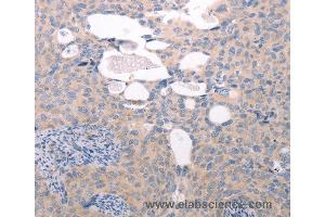 Immunohistochemistry of Human liver cancer using ABCF1 Polyclonal Antibody at dilution of 1:40