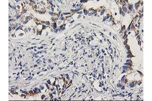 Immunohistochemical staining of paraffin-embedded Carcinoma of Human lung tissue using anti-PNMT mouse monoclonal antibody. (PNMT antibody)
