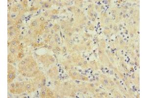Immunohistochemistry of paraffin-embedded human liver cancer using ABIN7151102 at dilution of 1:100 (Pellino 3 antibody  (AA 1-280))
