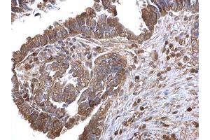 IHC-P Image LOXL2 antibody detects LOXL2 protein at cytosol on human ovarian carcinoma by immunohistochemical analysis.