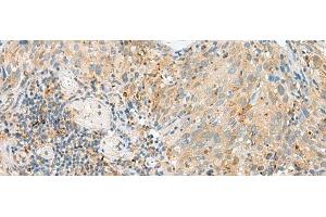 Immunohistochemistry of paraffin-embedded Human cervical cancer tissue using CNPY3 Polyclonal Antibody at dilution of 1:55(x200) (TNRC5 antibody)