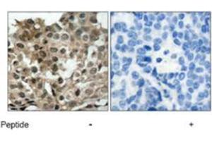 Immunohistochemical analysis of paraffin-embedded human breast carcinoma tissue using FOXO3 polyclonal antibody  . (FOXO3 antibody)