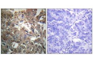 Immunohistochemistry analysis of paraffin-embedded human breast carcinoma tissue using XPA antibody. (XPA antibody  (C-Term))