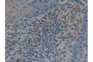 IHC-P analysis of Human Skin Cancer Tissue, with DAB staining.