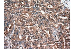 Immunohistochemical staining of paraffin-embedded Adenocarcinoma of colon using anti-NTF3 (ABIN2452548) mouse monoclonal antibody. (Neurotrophin 3 antibody  (AA 139-257))
