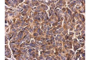 IHC-P Image Survivin antibody detects Survivin protein at cytosol on human breast carcinoma by immunohistochemical analysis. (Survivin antibody)