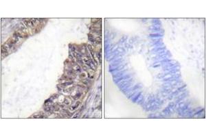 Immunohistochemistry analysis of paraffin-embedded human colon carcinoma, using GIRK1/KIR3. (KCNJ3 antibody  (pSer185))