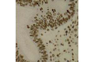 Immunohistochemistry of paraffin-embedded human uterine cancer using NFKB2 antibody at dilution of 1:200 (400x lens). (NFKB2 antibody)
