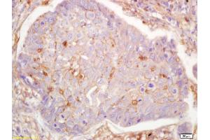 Formalin-fixed and paraffin embedded human lung carcinoma labeled with Anti-G protein alpha S Polyclonal Antibody, Unconjugated (ABIN751438) at 1:200 followed by conjugation to the secondary antibody and DAB staining. (G Protein alpha S (AA 901-1037) antibody)