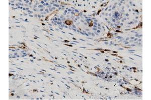 Immunohistochemical staining of paraffin-embedded Carcinoma of Human kidney tissue using anti-ARHGAP25 mouse monoclonal antibody. (ARHGAP25 antibody)