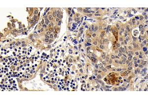 Detection of Bcl2L in Human Lymphoma Tissue using Monoclonal Antibody to B-Cell CLL/Lymphoma 2 Like Protein (Bcl2L) (BCL2L1 antibody  (AA 2-212))