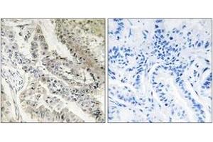 Immunohistochemistry analysis of paraffin-embedded human lung carcinoma tissue, using CRBP III Antibody. (Retinol Binding Protein 5 antibody  (AA 10-59))
