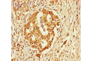 Immunohistochemistry of paraffin-embedded human pancreatic cancer using ABIN7152927 at dilution of 1:100 (FBLN7 antibody  (AA 25-393))