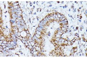 Immunohistochemistry of paraffin-embedded Human colon carcinoma using PPP2CB Polyclonal Antibody at dilution of 1:100 (40x lens). (PPP2CB antibody)