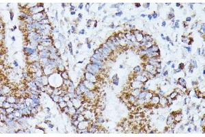 Immunohistochemistry of paraffin-embedded Human colon carcinoma using PPP2CB Polyclonal Antibody at dilution of 1:100 (40x lens). (PPP2CB antibody)