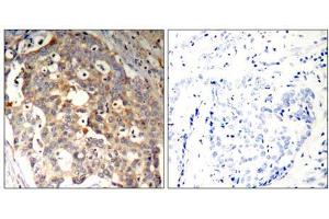 Immunohistochemical analysis of paraffin-embedded human breast carcinoma tissue using SAPK/JNK (Ab-183) Antibody (E021241). (SAPK, JNK antibody)