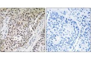 Immunohistochemistry analysis of paraffin-embedded human lung carcinoma tissue, using ZNF608 Antibody. (ZNF608 antibody  (AA 1231-1280))