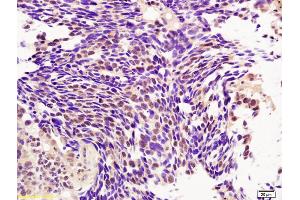 Formalin-fixed and paraffin embedded human lung carcinoma labeled with Rabbit Anti BMI1/PCGF4 Polyclonal Antibody, Unconjugated (ABIN682678) at 1:200 followed by conjugation to the secondary antibody and DAB staining (BMI1 antibody  (AA 61-160))