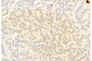 ABIN6265170 and ABIN6269368 at 1/100 staining Human lung cancer by IHC-P.